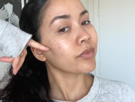 Can Your Haircare Routine Be Causing Breakouts?